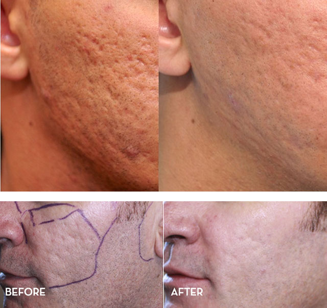 Как можно быстро залечить рану от прыща