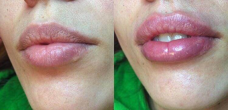 увеличение губ в Москве: до и после