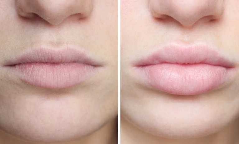 Фото до и после филлера Принцесс