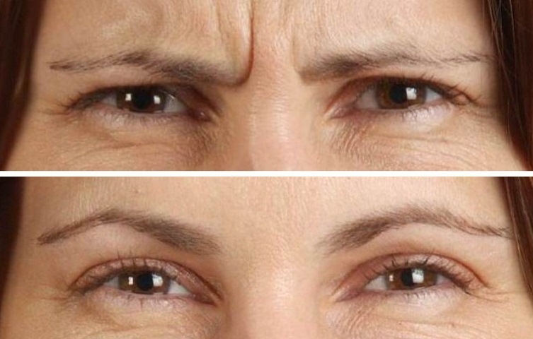 До и после ботокса