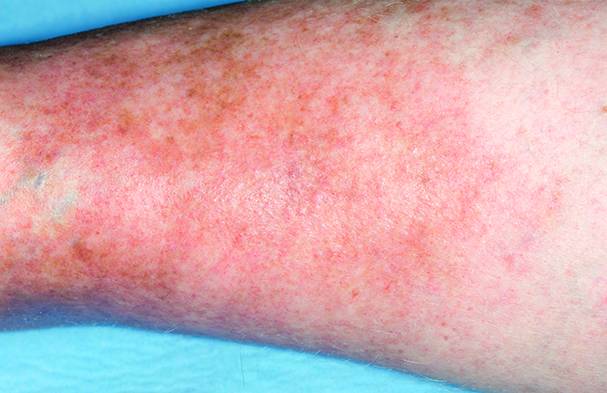 варикозная экзема фото