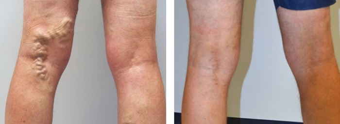 фото до и после флебэктомии