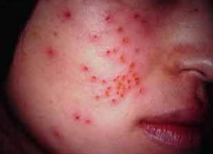 вирус простого герпеса фото на щеках