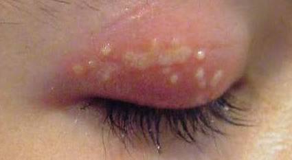 вирус простого герпеса фото на веках
