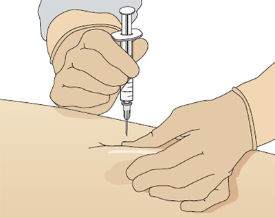 Уколы внутримышечно Мильгамма - инструкция по применению