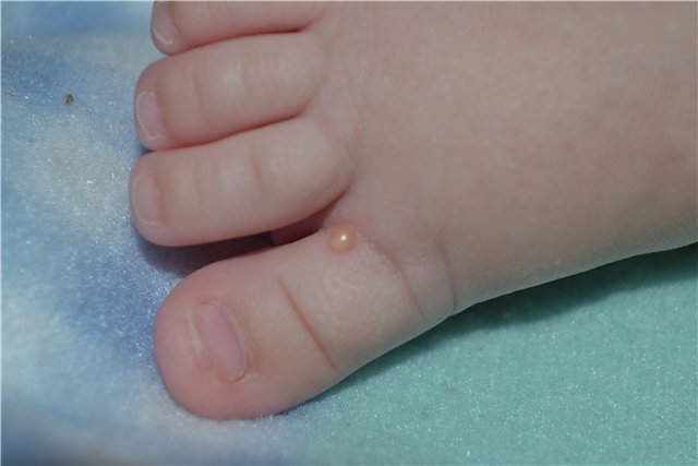 vodyanistye-pryshhiki-u-rebenka-foto