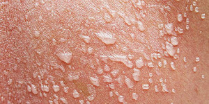 vodyanye-puzyrki-na-kozhe