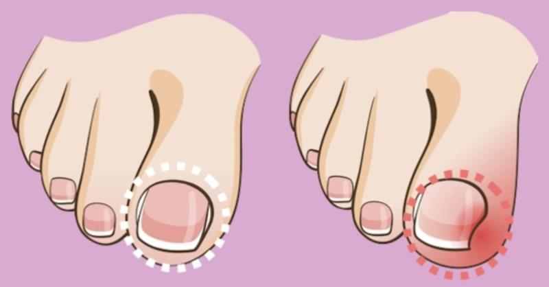 Вросший ноготь на ноге: лечение патологии