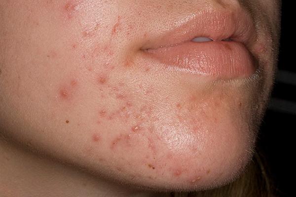 vulgarnye-ugri-chto-eto-takoe-foto-1