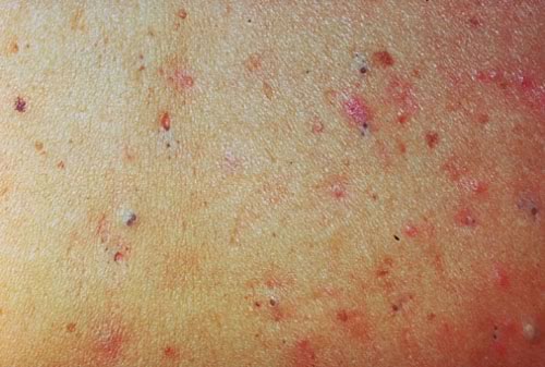 vulgarnye-ugri-chto-eto-takoe-foto