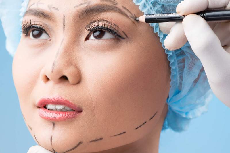 разметка на лице перед операцией