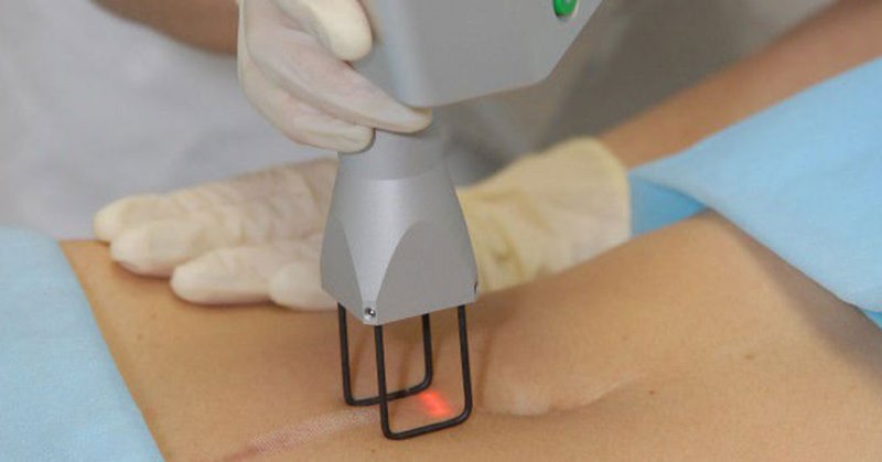 Удаление шрамов лазером