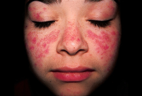 Красная волчанка заразна или нет?