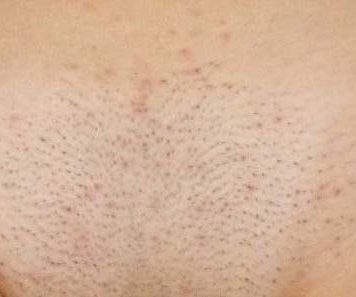 Прыщи на лобке - почему появились, что значиат и как лечить